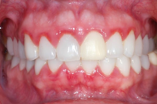 Hôi miệng: Nguyên nhân, đối tượng nguy cơ và cách phòng ngừa 5 Viêm nướu