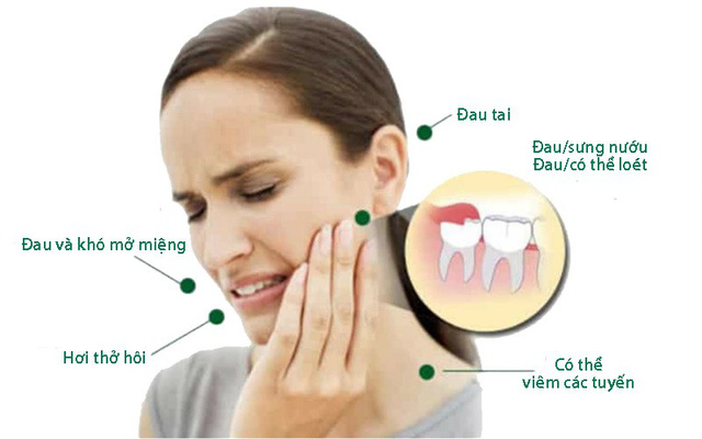 Biến chứng mọc răng khôn