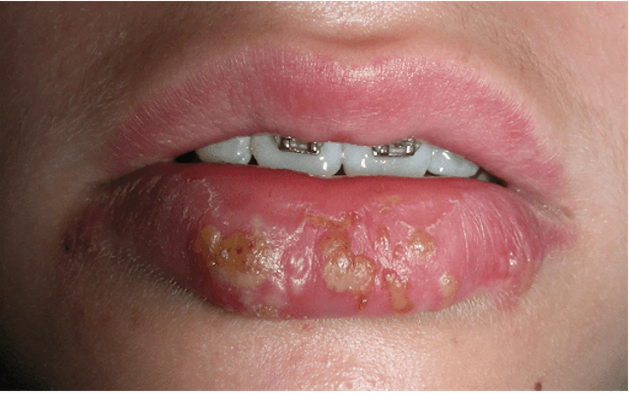 Lở Miệng Do Vi Rút Herpes: Nguyên Nhân, Triệu Chứng Và Cách Điều Trị Hiệu Quả 7 hpm3