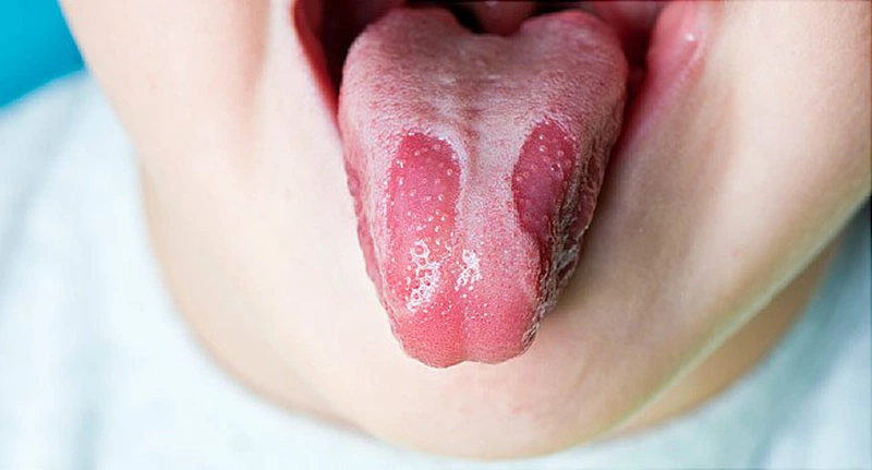 Lưỡi Địa Lý: Nguyên Nhân, Triệu Chứng Và Cách Điều Trị 6 Hình ảnh lưỡi địa lý