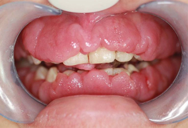 Viêm Lợi Phì Đại: Nguyên Nhân, Triệu Chứng và Phương Pháp Điều Trị Hiệu Quả 7 Hình ảnh viêm lợi phì đại