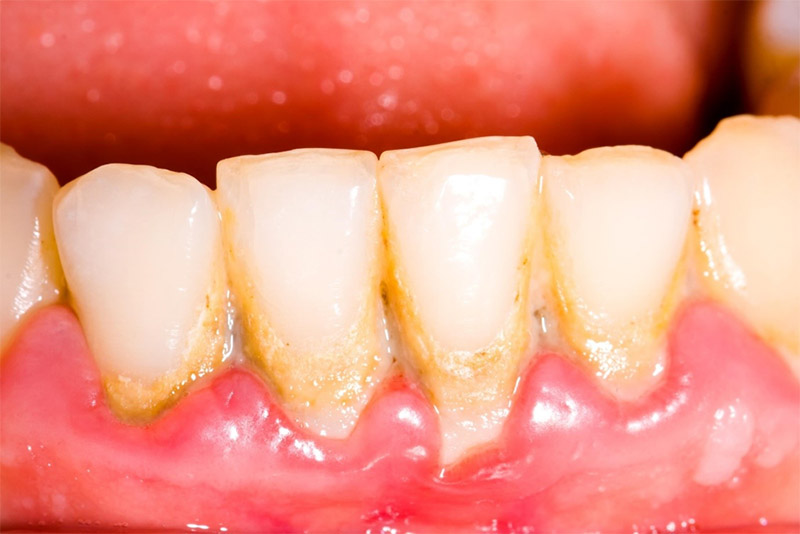 Viêm Lợi Phì Đại: Nguyên Nhân, Triệu Chứng và Phương Pháp Điều Trị Hiệu Quả 8 Mảng bám gây nên viêm lợi phì đại