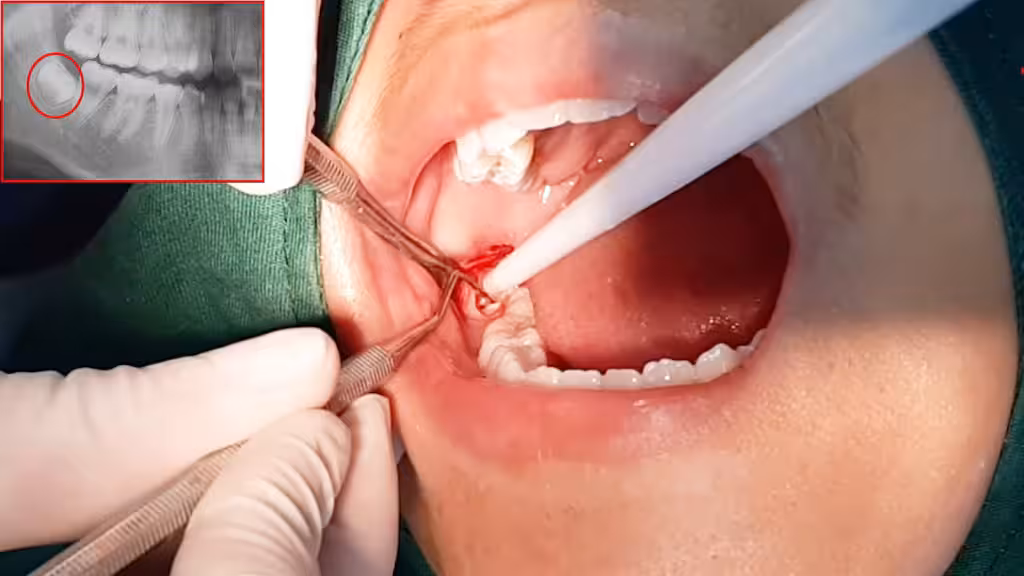 Nhổ răng khôn tại phòng khám