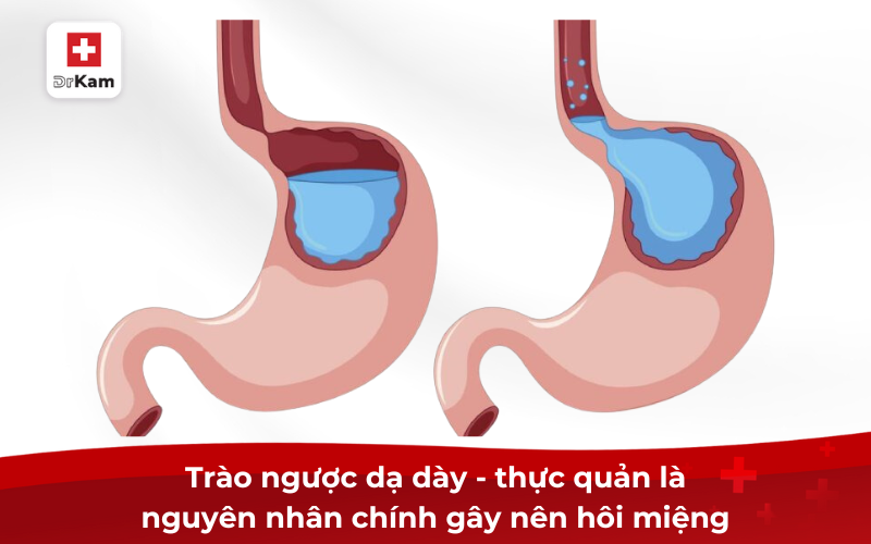 Trào ngược dạ dày - thực quản là nguyên nhân chính gây nên hôi miệng