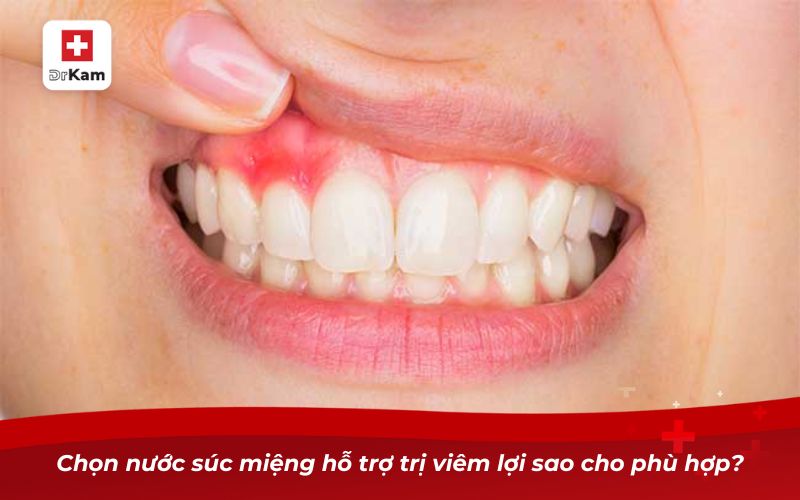 Chọn nước súc miệng hỗ trợ trị viêm lợi sao cho phù hợp?
