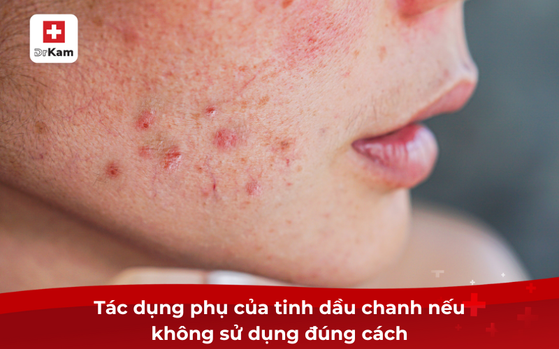 Tinh dầu chanh và lợi ích vượt trội cho sức khỏe 5 Tác dụng phụ của tinh dầu chanh nếu không sử dụng đúng cách