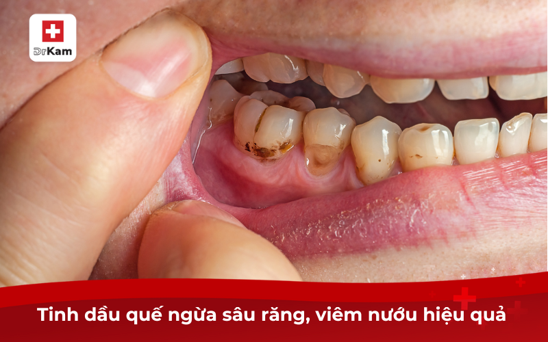 Tìm hiểu về tinh dầu quế và tác dụng đối với sức khỏe 3 Tinh dầu quế ngừa sâu răng, viêm nướu hiệu quả