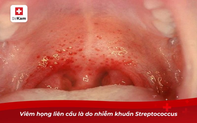Hình ảnh viêm họng liên cầu khuẩn và những điều cần biết 2 Viêm họng liên cầu là do nhiễm khuẩn Streptococcus