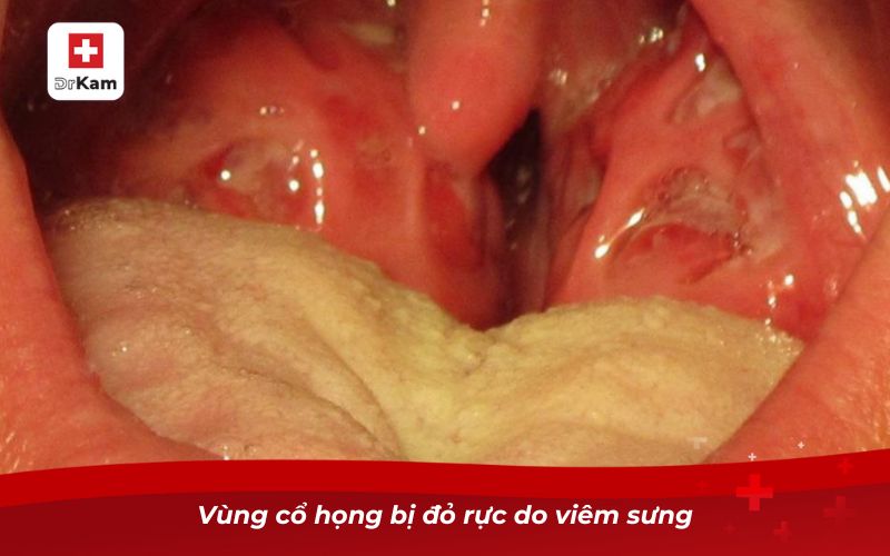 Hình ảnh viêm họng liên cầu khuẩn và những điều cần biết 3 Vùng cổ họng bị đỏ rực do viêm sưng