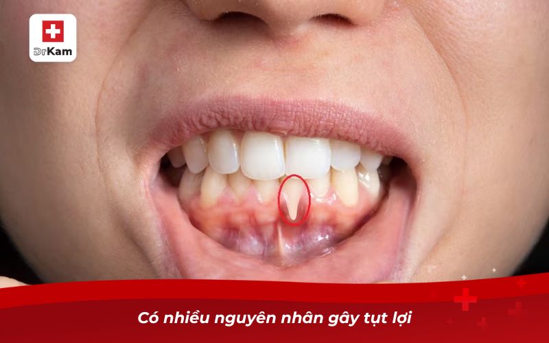Nước súc miệng chữa tụt lợi giúp phục hồi nướu hiệu quả 3 Có nhiều nguyên nhân gây tụt lợi