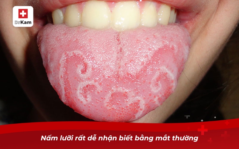 Nấm lưỡi rất dễ nhận biết bằng mắt thường