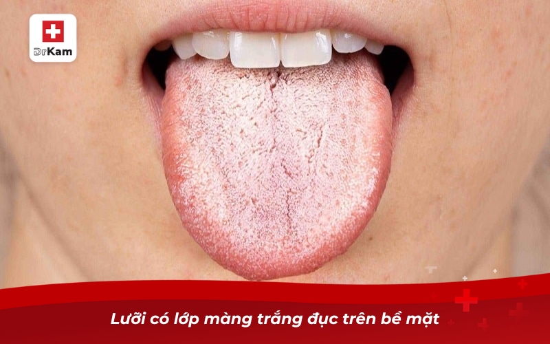 Lưỡi có lớp màng trắng đục trên bề mặt
