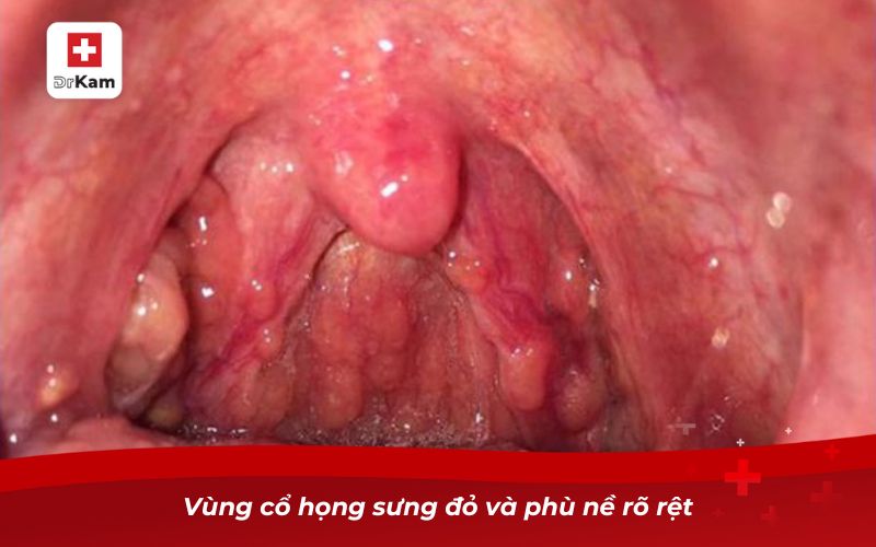 Vùng cổ họng sưng đỏ và phù nề rõ rệt