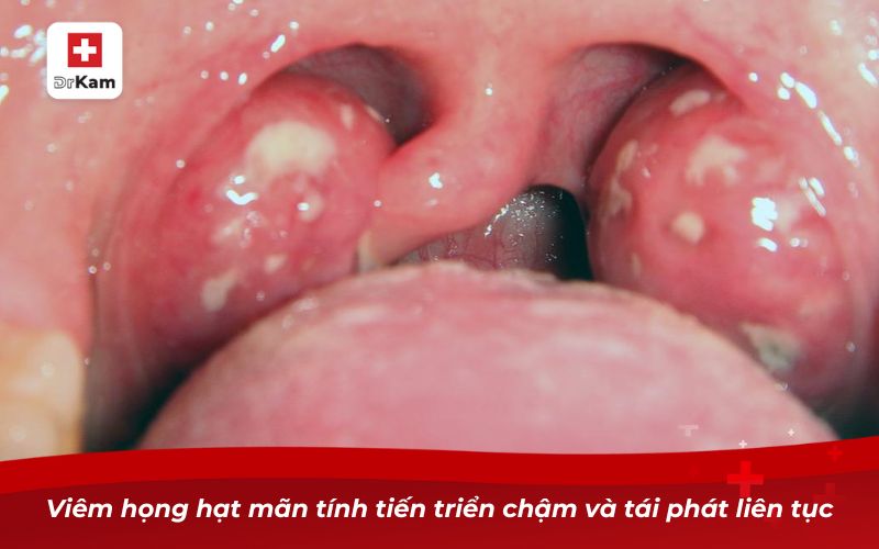 Viêm họng hạt mãn tính tiến triển chậm và tái phát liên tục