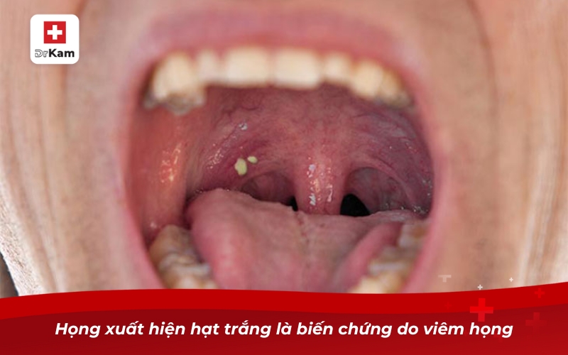 Họng xuất hiện hạt trắng là biến chứng do viêm họng