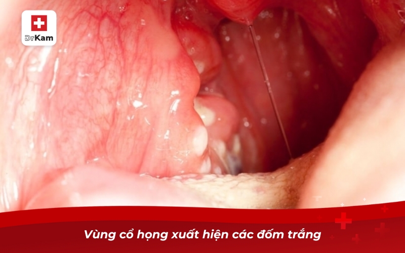 Vùng cổ họng xuất hiện các đốm trắng