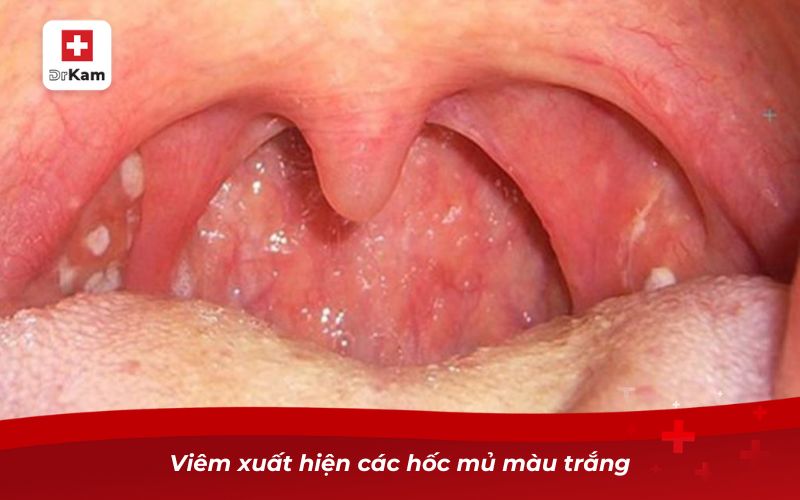 10 cách chữa viêm amidan hốc mủ tại nhà an toàn, hiệu quả 2 Viêm xuất hiện các hốc mủ màu trắng