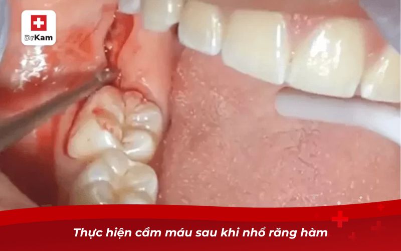 Cách nhổ răng hàm bị sâu tại nhà đơn giản và an toàn 6 cach nho rang ham bi sau tai nha 3 1
