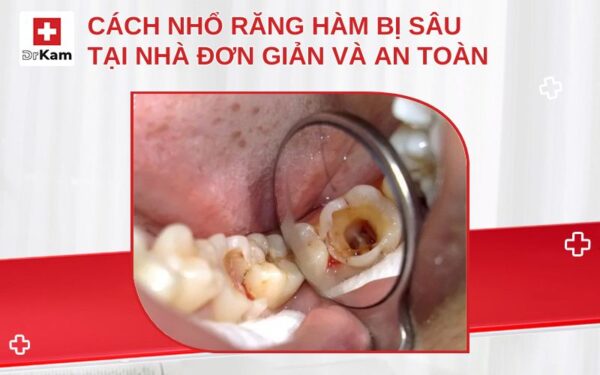 Cách nhổ răng hàm bị sâu tại nhà đơn giản và an toàn