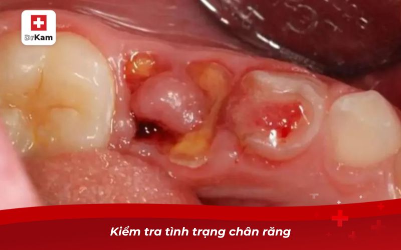 Kiểm tra tình trạng chân răng