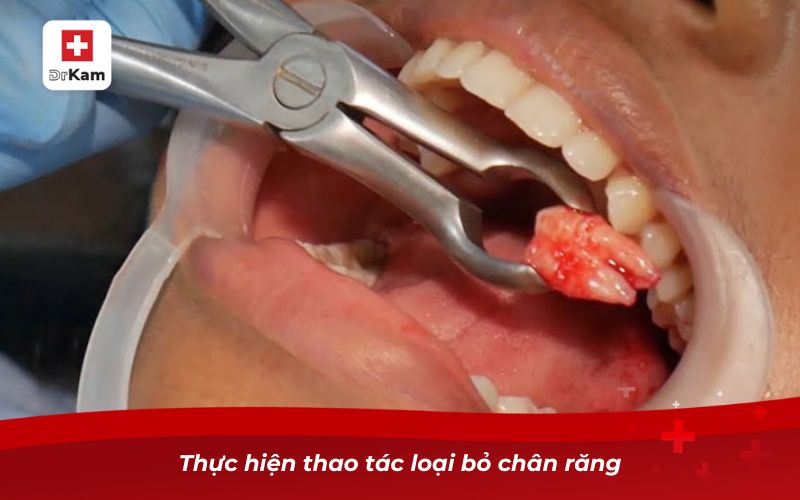 Thực hiện thao tác loại bỏ chân răng