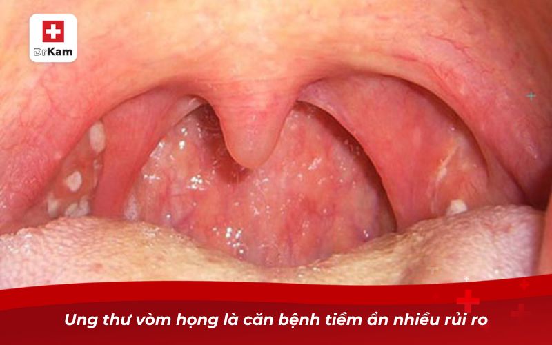 Ung thư vòm họng là căn bệnh tiềm ẩn nhiều rủi ro