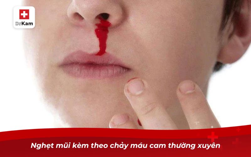 Nghẹt mũi kèm theo chảy máu cam thường xuyên