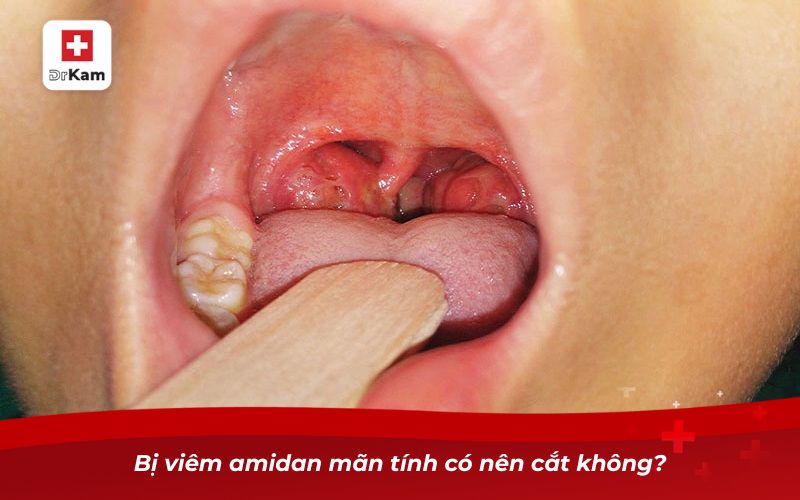 Viêm amidan mãn tính có nên cắt không? 2 Bị viêm amidan mãn tính có nên cắt không?