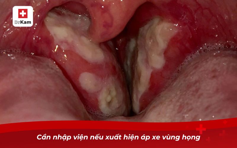 Viêm họng có tự khỏi không? Bí quyết xử lý bệnh hiệu quả 5 Cần nhập viện nếu xuất hiện áp xe vùng họng