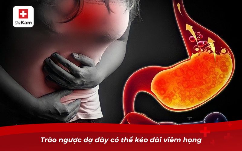 Trào ngược dạ dày có thể kéo dài viêm họng
