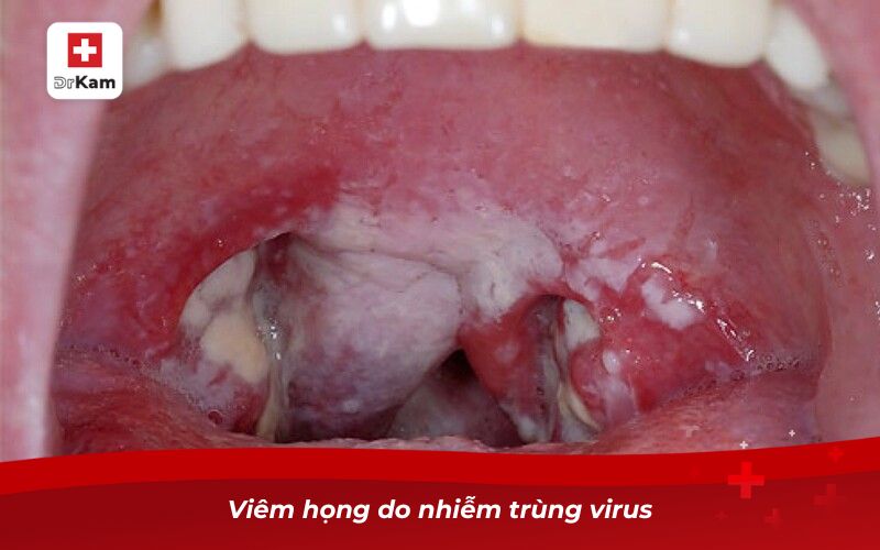 Viêm họng do nhiễm trùng virus