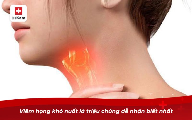 Viêm họng khó nuốt là triệu chứng dễ nhận biết nhất
