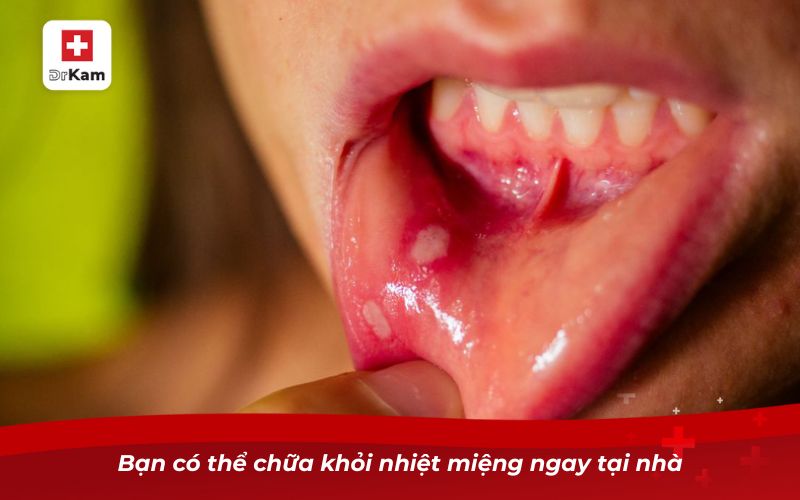 Bạn có thể chữa khỏi nhiệt miệng ngay tại nhà