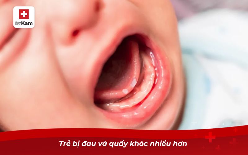 Hình ảnh nhiệt miệng ở trẻ sơ sinh và cách nhận biết sớm 2 Trẻ bị đau và quấy khóc nhiều hơn