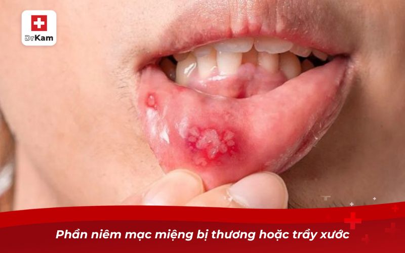 Phần niêm mạc miệng bị thương hoặc trầy xước
