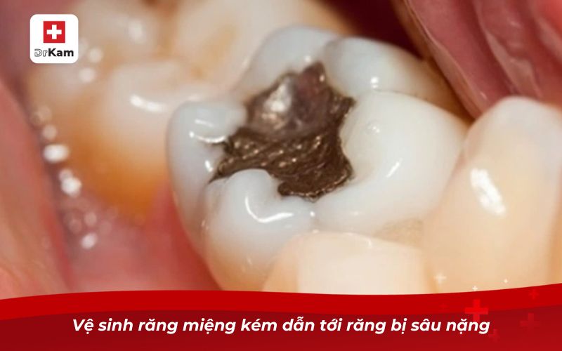 Răng bị sâu lỗ to phải làm sao? Giải pháp dứt điểm hiệu quả 2 Vệ sinh răng miệng kém dẫn tới răng bị sâu nặng