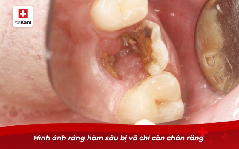 Hình ảnh răng hàm sâu bị vỡ chỉ còn chân răng 