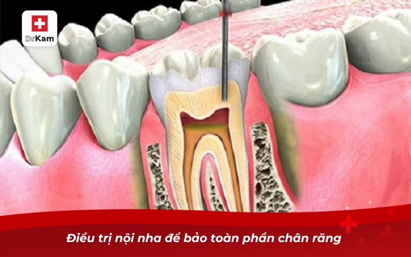 Điều trị nội nha để bảo toàn phần chân răng 