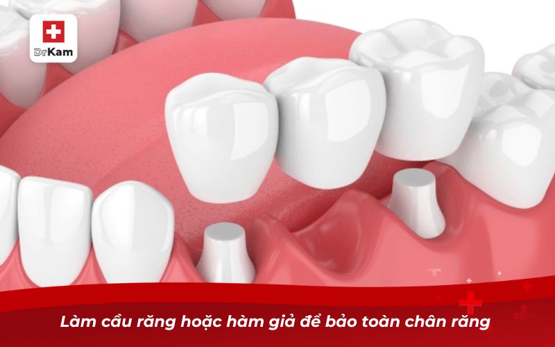 Làm cầu răng hoặc hàm giả để bảo toàn chân răng 