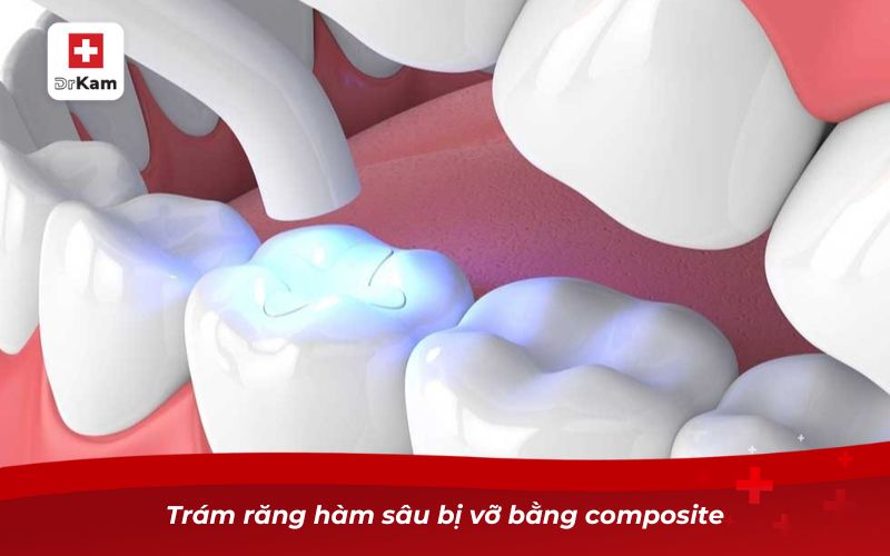 Trám răng hàm sâu bị vỡ bằng composite