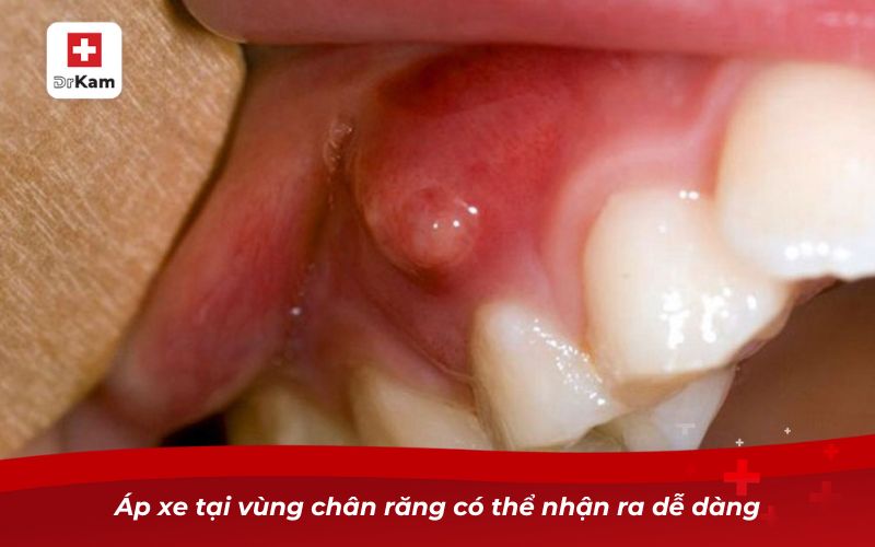 Răng không sâu nhưng bị nhức – Nguyên nhân và cách khắc phục 3 Áp xe tại vùng chân răng có thể nhận ra dễ dàng