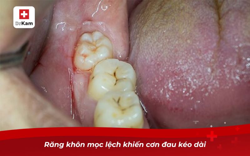 Răng không sâu nhưng bị nhức – Nguyên nhân và cách khắc phục 4 Răng khôn mọc lệch khiến cơn đau kéo dài