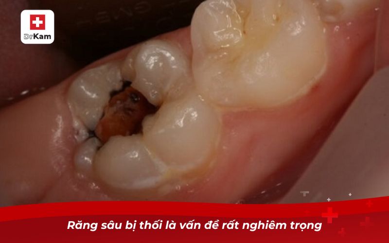 Răng sâu bị thối là vấn đề rất nghiêm trọng 