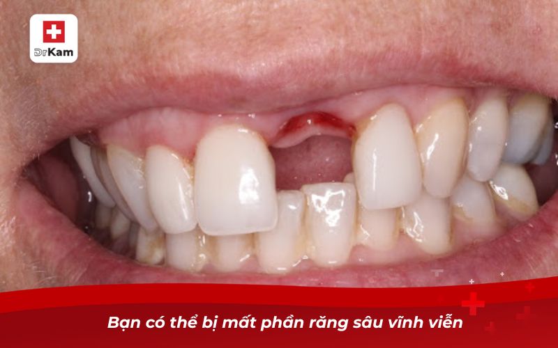 Bạn có thể bị mất phần răng sâu vĩnh viễn