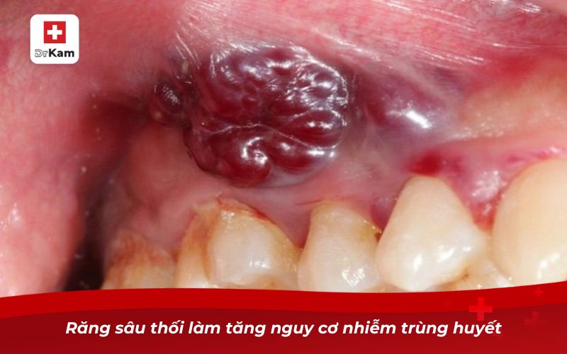 Răng sâu thối làm tăng nguy cơ nhiễm trùng huyết