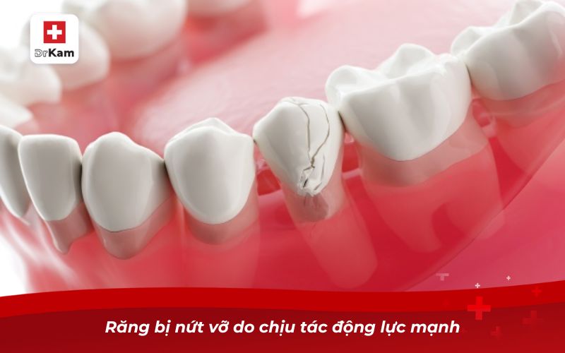 Răng sâu bị vỡ hết - Nguyên nhân và cách xử lý 3 Răng bị nứt vỡ do chịu tác động lực mạnh