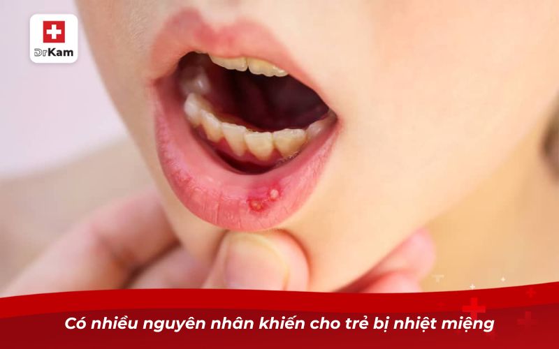 Có nhiều nguyên nhân khiến cho trẻ bị nhiệt miệng