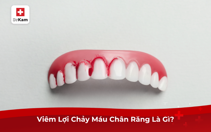 Cách Điều Trị Và Phòng Ngừa Viêm Lợi Chảy Máu Chân Răng 2 Viêm Lợi Chảy Máu Chân Răng Là Gì?