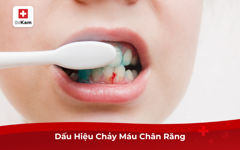 8 Bài Thuốc Dân Gian Chữa Chảy Máu Chân Răng 2 Dấu hiệu chảy máu chân răng