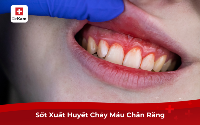 Sốt Xuất Huyết Chảy Máu Chân Răng
